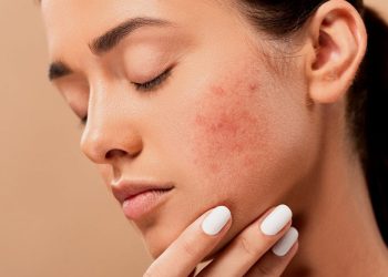 جوش های زیر پوستی
